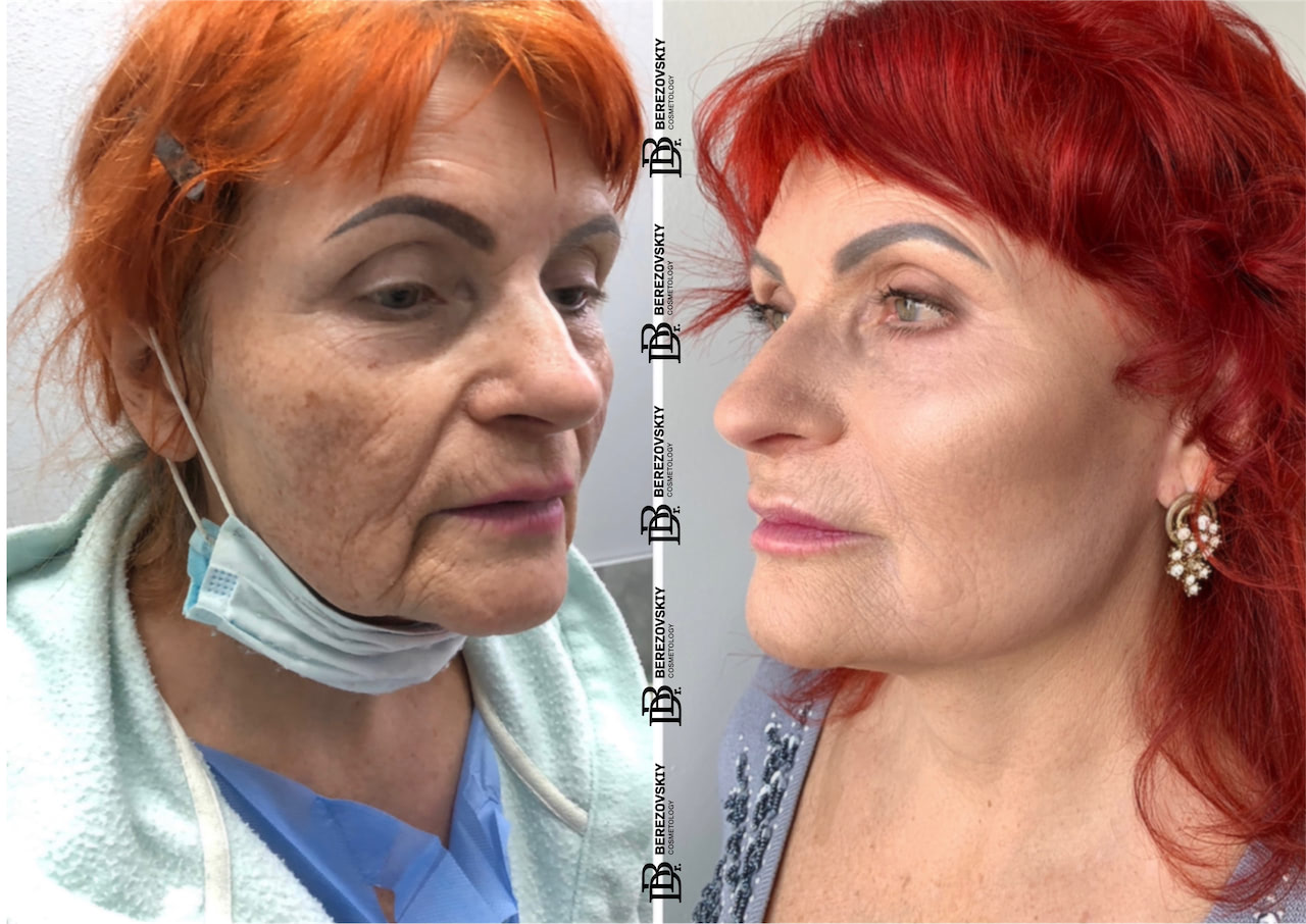 Підтяжка обличчя в Києві - ціна та відгуки на фейсліфтинг у Docber Clinic
